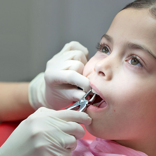 Удаление постоянных зубов у детей